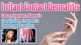 Irritant contact dermatitis overview causes symptoms treatment options and home remedies [upl. by Rehpotsrhc]