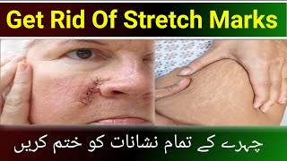 Stretch marks removal serum  stitches scars reduce serum  Dr review fade scars serum [upl. by Ahsiena422]