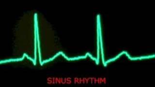 audible heart beat  extrasystoles  PVC and sinus beats [upl. by Lipkin]