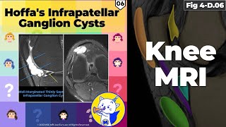 Fig 4D06 Hoffa’s Fat Pad Ganglion Cysts [upl. by Dippold]