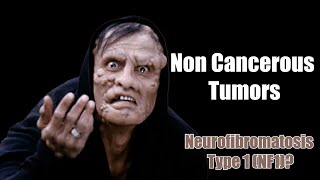 Noncancerous Tumors  What You Need to Know About Neurofibromatosis Type 1 NF1 [upl. by Eerbua746]