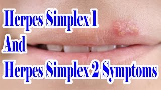 Herpes Simplex 1 And 2 Symptoms  Which Herpes You Are Suffering From HSV 1 Or HSV 2 [upl. by Kuhlman548]