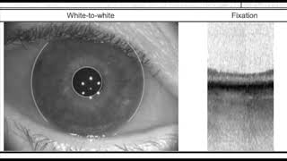 Biometry basics with the IOL master 700 [upl. by Blodget]