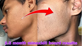 Minoxidil beard growth  2 month beard journey  transformation [upl. by Thisbee67]