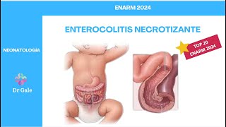 NEONATOLOGÍA  ENTEROCOLITIS NECROTIZANTE  ENARM 2024 [upl. by Rad]