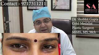 What is Xanthelasma Removal Treatment  Dr Shobhit Gupta Xanthelasma Laser Removal Before and After [upl. by Eednar]