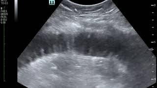 Bedside Ultrasound for the Diagnosis of Small Bowel Obstruction JETem 2017 [upl. by Avuha213]