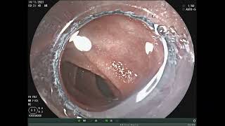 intestinal lymphangiectasia endoscopy [upl. by Eiznekam]