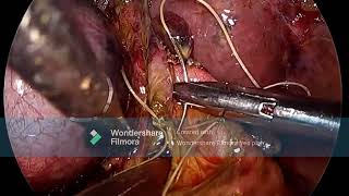 LAPAROSCOPIC CBD EXPLORATION FOR CHOLEDOCHOLITHIASIS LAST PART [upl. by Ayatahs]