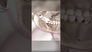 Corrective Jaw Surgery Orthognathic Surgery [upl. by Nahpets719]