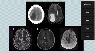 Neuroradiology meeting Pediatric brain tumors [upl. by Llewen]