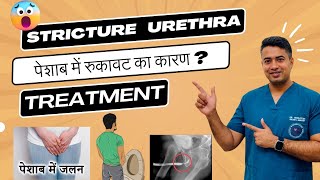 Urethral Stricture Symptoms Causes amp Treatment  Dr Venkatesh Kumar noida greaternoida [upl. by Ettenan19]