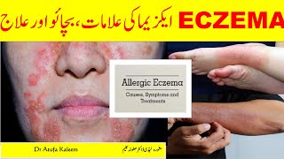 Eczema Symptoms Treatment and Triggers  What is Atopic Dermatitis  Eczema explained in Urdu Hindi [upl. by Nnylyt430]