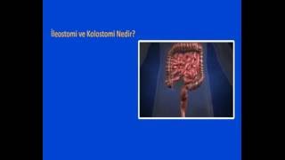 Stoma Nedir  Kolostomi ve İleostomi Nedir  Stoma Çıkışı ve Ürostomi [upl. by Fabiolas289]