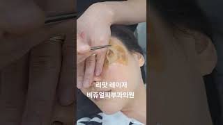 리팟 레이저 다발성 흑자 세종리팟 세종시리팟 reepot lentigo multiplelentigo 청주리팟 공주리팟 대전리팟 오창리팟 오송리팟 부여리팟 [upl. by Ireland]