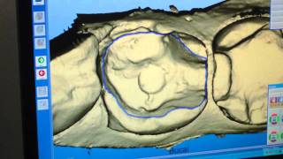 Diseño de incrustación en sistema CADCAM Cerec Godín Odontolgía Cali valle [upl. by Paton]