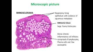 Rhinoscleroma [upl. by Susi]