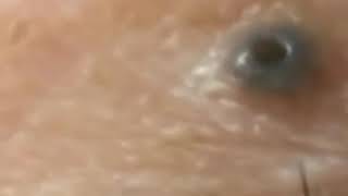 Super SATISFYING BLACKHEAD REMOVAL on November 2020 [upl. by Aicinad]