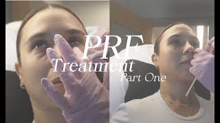 PRF Under Eye Treatment  Pt 1 [upl. by Neral]