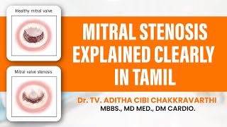 Mitral Stenosis Explained in Tamil [upl. by Anelahs]