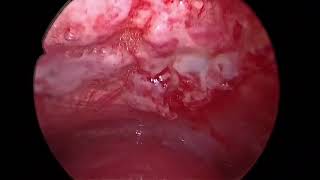 Rigid Thoracoscopy  Pleural Biopsy  Talc Poudrage  Malignant Pleural effusion [upl. by Llenrod]