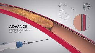 OUTBACK™ Elite ReEntry Catheter Product Highlights [upl. by Karame471]