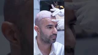 Are you struggling with thinning hair or balding areas  Cosmotheics  Skin Care and Dental Clinic [upl. by Iorgo]