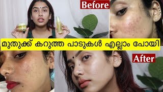 സത്യം പറ😡 ഇത് എങ്ങനെ പോയത് 💯 How to Get Clear skin at home 🏡 glamygangaskincare [upl. by Anahsohs]