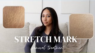 STRETCH MARK REMOVAL TREATMENT MY RESULTS [upl. by Jamieson534]