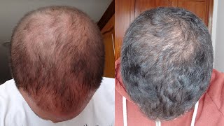 RECUPERACIÓN de CABELLO SIN TRASPLANTE CAPILAR  Caso real SUSCRIPTOR [upl. by Notrub]