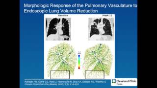 Pulmonary Arterial Hypertension in COPD and ILD [upl. by Just124]