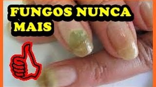 ♥Como Acabar com os Fungos das Unhas Receita Caseira [upl. by Ojyram]