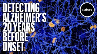 Detecting Alzheimers 20 years before onset [upl. by Clere637]