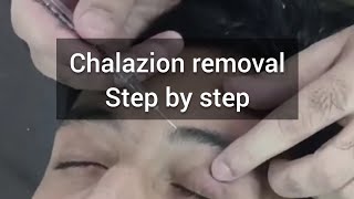 Chalazion removal 👁️ [upl. by Geier]