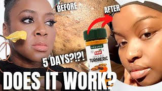 Does this DIY Turmeric Mask for Hyperpigmentation REALLY Work [upl. by Odele400]