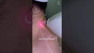 Laser hair removal mark for precision save target Area relatively painless [upl. by Areip]