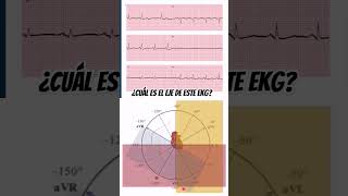 Calcula el eje en el Electrocardiograma EKG 1 método vectorial [upl. by Lau134]