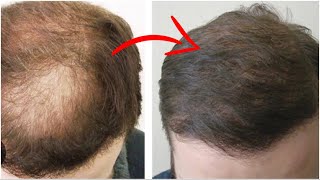 Hair Transplant for Diffuse Thinning Shocking results [upl. by Jody]