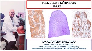 FOLLICULAR LYMPHOMA PART1 BY DR WAFAEY BADAWY [upl. by Iegres]