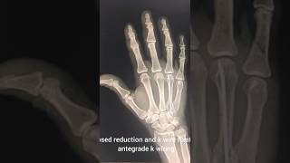 hand fracture metacarpalkwireudupi kundapura brahmavara kota manipal orthopaedics ortho [upl. by Sitoiyanap624]