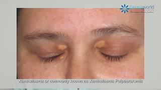 What is Xanthelasma   Dr Rohit Batra explains [upl. by Llamaj975]