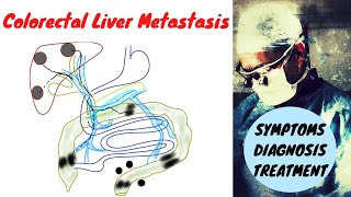 Stage 4 Colon Cancer Liver Metastasis Symptoms Diagnosis Treatment [upl. by Rossner]