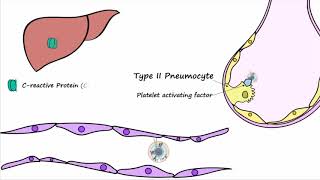 Bacterial Pneumonia  Pathogenesis [upl. by Philippe]