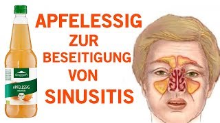 Wie du eine Sinusitis innerhalb von Minuten mit Apfelessig los wirst [upl. by Benton]