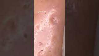 Pickel Ausdrücken Blackheads Akne amp Mitesser entfernen 🔴 29 [upl. by Anik324]