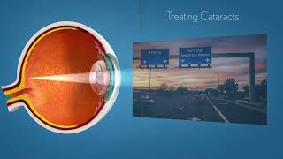 Unlock Clear Vision enVista Toric Cataract amp Astigmatism Solutions [upl. by Efar427]