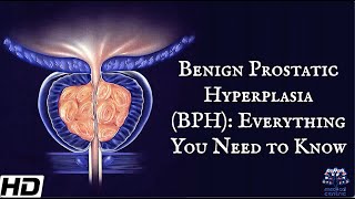 Benign Prostatic Hyperplasia BPH Everything You Need To Know [upl. by Alviani985]