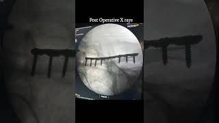 Clavicle Fracture Treatment  fracture shorts neckexercises shortsvideo [upl. by Carrew]