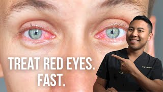 How to get rid of red eyes FAST  Ophthalmologist MichaelRChuaMD [upl. by Osmund630]