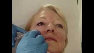 Injecting Platelet Rich Plasma around the eye [upl. by Colier]